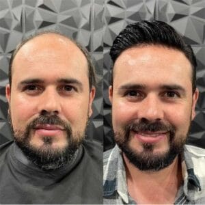 Results of Hair Transplant in Islamabad, Pakistan