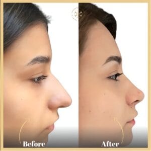 Alarplasty in Islamabad