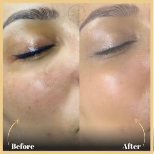 BB Glow Treatment in Islamabad