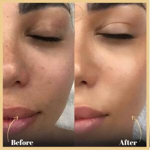 BB Glow Treatment in Islamabad