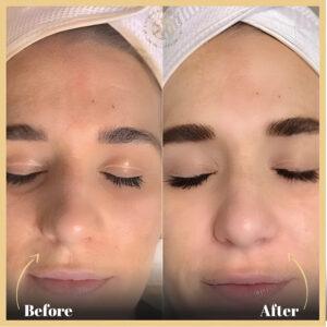 BB Glow Treatment in Islamabad