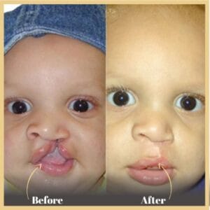 Cleft Lip and Palate Treatment in Islamabad