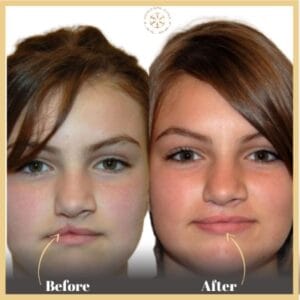 Cleft Lip and Palate Treatment in Islamabad