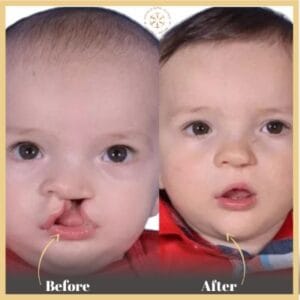 Cleft Lip and Palate Treatment in Islamabad