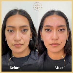Dark Circles Treatment in Islamabad