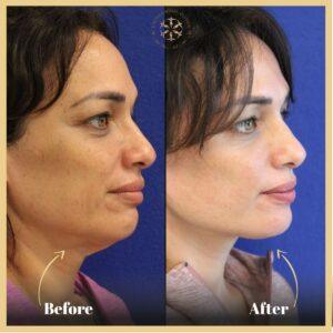 Non Surgical Facelift in Islamabad