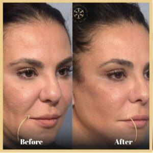 Non Surgical Facelift in Islamabad
