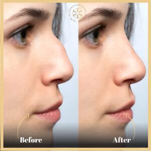 Nose Fillers Injections in Islamabad