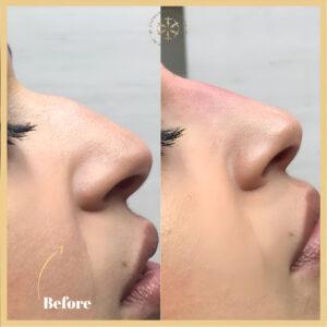 Nose Fillers Injections in Islamabad