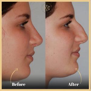 Nose Fillers Injections in Islamabad