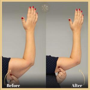 Saggy Skin Treatment