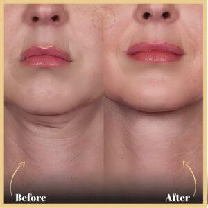 Saggy Skin Treatment