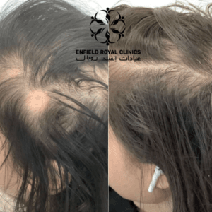before after alopecia areata in islamabad