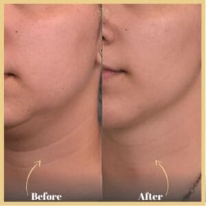 Buccal Fat Removal in Islamabad Pakistan