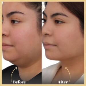 Buccal Fat Removal in Islamabad Pakistan