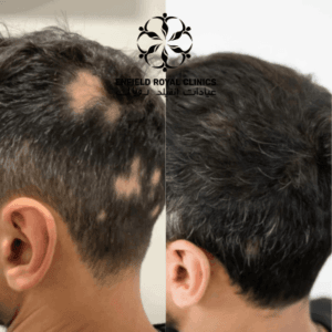 images of alopecia areata in Islamabad