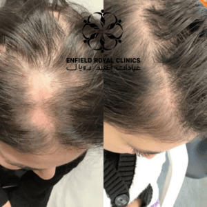 results of alopecia areata in Islamabad