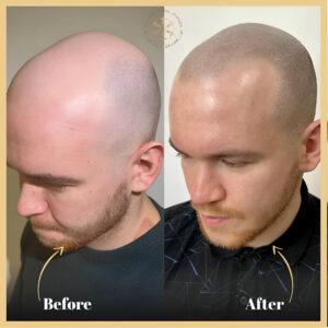 Scalp Micropigmentation Treatment in Islamabad