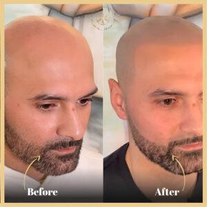 Scalp Micropigmentation Treatment in Islamabad