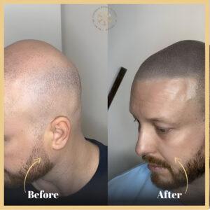 Scalp Micropigmentation Treatment in Islamabad