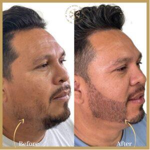 Beard Hair Transplant in Islamabad