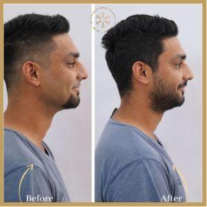 Beard Hair Transplant in Islamabad