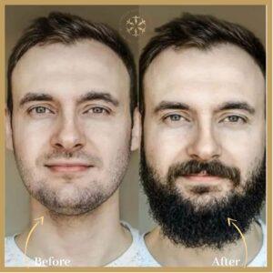 Beard Hair Transplant in Islamabad