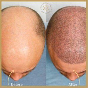 FUE Hair Transplant In Islamabad