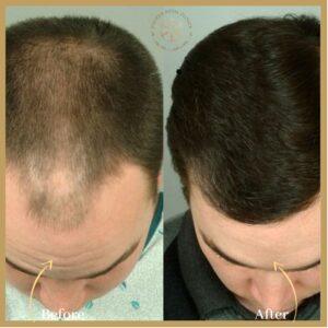 FUE Hair Transplant In Islamabad