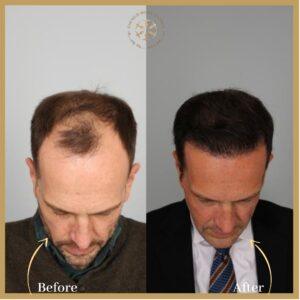 FUE Hair Transplant In Islamabad