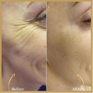 Fine line and Wrinkles Treatment