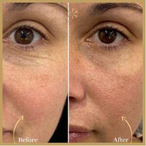 Fine line and Wrinkles Treatment