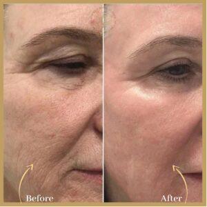 Fine line and Wrinkles Treatment