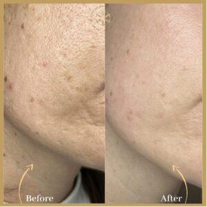 Fractional CO2 Laser Scar in Islamabad
