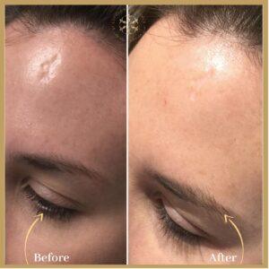Fractional CO2 Laser Scar in Islamabad