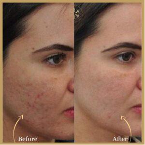 Fractional CO2 Laser Scar in Islamabad