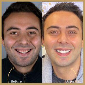 Gum Grafting in Islamabad