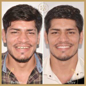 Invisalign Treatment in islamabad