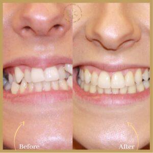 Invisalign Treatment in islamabad