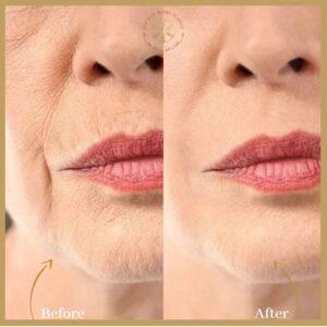 Profhilo injections in islamabad