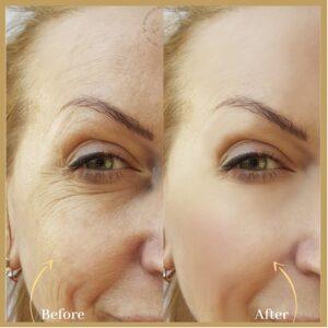 Profhilo injections in islamabad