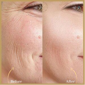 Profhilo injections in islamabad