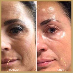 Skin Rejuvenation