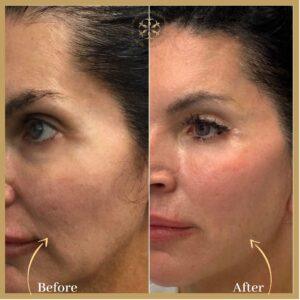 Skin Rejuvenation