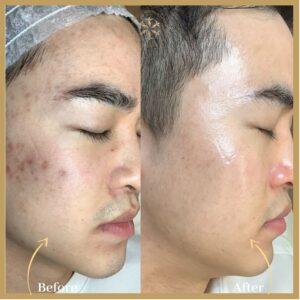 Skin Rejuvenation