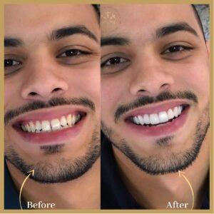 Teeth Scaling in Islamabad