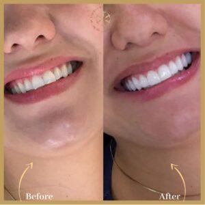 Teeth Scaling in Islamabad