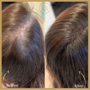 Exosome Hair Therapy