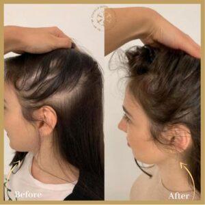 Exosome Hair Therapy