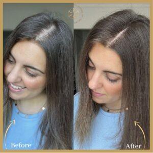 Exosome Hair Therapy